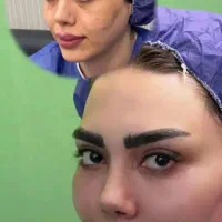 آموزش مدل فیلربوتاکس گازی انزیم هیرنوا هایفوبیکینی