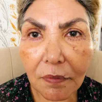 بلفاروپلاستی با۲تومن تخفیف فقط فردا ۳عصر|خدمات آرایشگری و زیبایی|قم, بلوار امین و ساحلی|دیوار