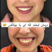 بوتاکس مصپورت۵۹۹ژل مجوزدار ۱/۲۰۰مادلینگ۵/۹۹۹|خدمات آرایشگری و زیبایی|قم, حاج زینل|دیوار