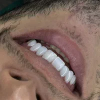 کامپوزیت و لمینت