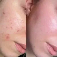 کربن تراپی. پیلینگ هالیوودی. پلاژن تراپی. فشیال