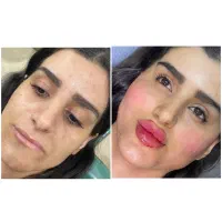 تزریق تخصصی فیلروبوتاکس و آنزیم توسط پزشک|خدمات آرایشگری و زیبایی|کرمانشاه, |دیوار