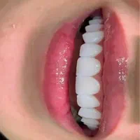 ونیر کامپوزیت جشنواره افتتاحیه فقط فکی ۹ م