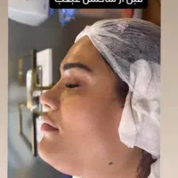 تخفیف عمل بینی لیفت رفع غبغب لیپو ابدو دایرکت ابرو|خدمات آرایشگری و زیبایی|قم, شاه ابراهیم|دیوار