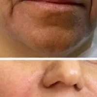 ساکشن چربی و تزریق ژل و بوتاکس و مزو لیفت شقیقه و.|خدمات آرایشگری و زیبایی|کرمانشاه, |دیوار