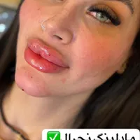 فیلر لب.بوتاکس.مزوژل.لب روسی.|خدمات آرایشگری و زیبایی|بندر انزلی, چهارفریضه|دیوار