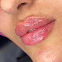 تززیق فیلر /بوتاکس /پی ارپی