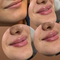 اف فیلرلب گونه چونه زاویه فقط 649|خدمات آرایشگری و زیبایی|محمدیه-قزوین, |دیوار