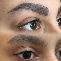 فیبروز میکروبلیدینگ