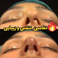 اف ویژه جراحی بینی و لیفت صورت در اهواز