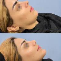 فیلر لب روسی فیلر زیر چشم فیلر گونه چانه توسط پزشک|خدمات زیبایی و سلامت|شیراز, ملاصدرا|دیوار