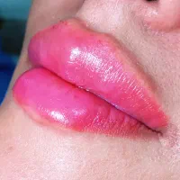 ژل و بوتاکس