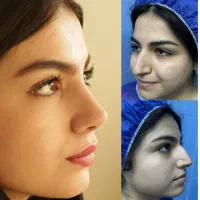 جراحی بینی درتهران، با آف ویژه