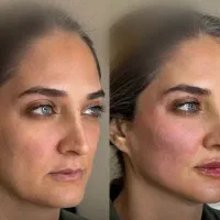 مزوی مو ،جوانسازی صورت ، زاویه سازی  و ساکشن غبغب