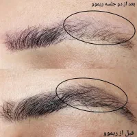 ریموور تتوهای قدیمی و تیره