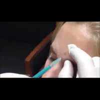 بوتاکس مزو مو و صورت