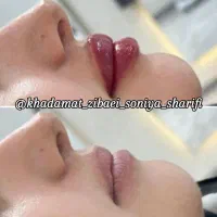 50 درصد تخفیف تزریقات ژل و بوتاکس|خدمات آرایشگری و زیبایی|اهواز, کوی رمضان|دیوار
