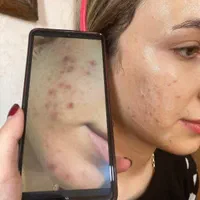 ٪۳۰ تخفیف فشیال و پاکسازی پوست و صورت در کلینیک|خدمات آرایشگری و زیبایی|قم, پردیسان|دیوار