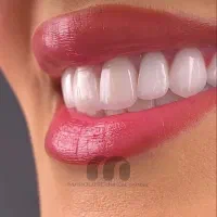 کامپوزیت و لمینیت دندان برند IPS EMAX|خدمات زیبایی و سلامت|تهران, پونک|دیوار