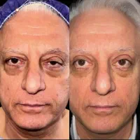 بوتاکس ، فیلر ، بلفاروپلاستی ، مزو