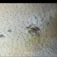 درمان گیاهی وسنتی زگیل های پوستی باترکیبات طبیعی