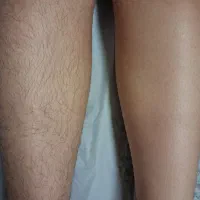 اپیلاسیون حرفه ای