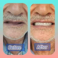 دندانسازی گشتی