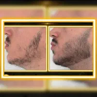 ۳۰ روزه ریشات پرپشت کن