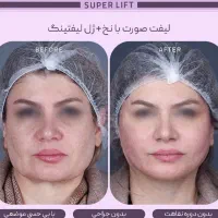 فیلرلب ژل پک کانتورینگ۴م لیفت بانخ prpرایگان