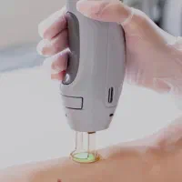 اپراتور با تجربه لیزر در فومن