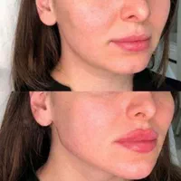 تخفیف ژل و فیلر فول فیس 3900 به جای ۷/۹۰۰|خدمات آرایشگری و زیبایی|اصفهان, خانه اصفهان|دیوار