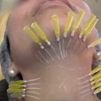 استثنایی توسط پزشک نخ کلاژن ساز