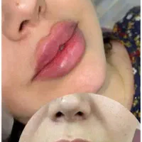 پزشک متخصص ژل و بوتاکس لیفت بانخ افزایش سایزآلت