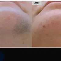 لیزر موهای زائد با چهارده سال سابقه کاری