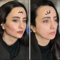 فول فیس،زاویه آقایان،ژل،بوتاکس زیربغل،فیلربادیprp|خدمات زیبایی و سلامت|تبریز, |دیوار