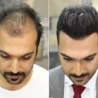 پروتز مو طبیعی