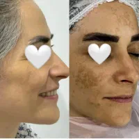 مدل /برای خدمات تخصصی پوست/ ریمووکک ومک