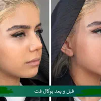 ساکشن غبغب وبوکال فت و چال گونه توسط پزشک در مطب|خدمات آرایشگری و زیبایی|مشهد, شهید فرامرز عباسی|دیوار