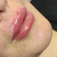 ژل بوتاکس|خدمات آرایشگری و زیبایی|دوگنبدان, |دیوار