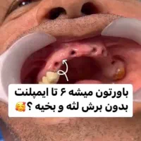 دندانپزشکی/ ایمپلنت دیجیتال با وام قرض الحسنه|خدمات آرایشگری و زیبایی|اصفهان, گلزار|دیوار
