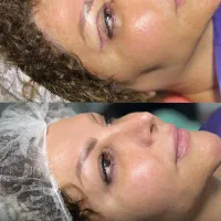 جراحی بلفارو پلاستی نیم بها|خدمات زیبایی و سلامت|تهران, فیروزآبادی|دیوار