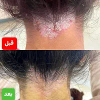 درمان وبدون برگشت بیماری های پیسی وپسوریازیس|خدمات آرایشگری و زیبایی|قم, آرامستان بهشت معصومه|دیوار