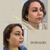 بوتاکس ژل فیلر چربی بلفاروپلاستی مزو PRP نخ لیزر|خدمات آرایشگری و زیبایی|شاهین‌شهر, فردوسی|دیوار