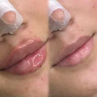 ژل لب،گونه،چانه،زاویه،شقیقه تخفیف عیدانه