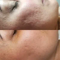 آموزش کامل مزونیدل بهمراه فیشال مزو فقط ۶۹۰۰