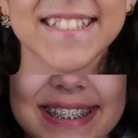 ارتودنسی.روکش.کامپوزیت.لمینت.عصب کشی