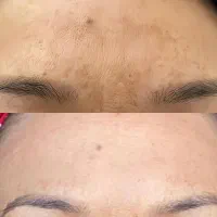 آموزش تخصصی فیشال و پاکسازی پوست از صفر تا حرفهای|خدمات آموزشی|ارومیه, |دیوار