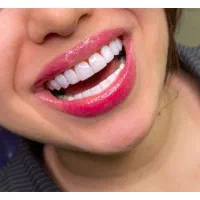 دندانپزشکی/ترمیم/کامپوزیت دندان/لمینیت/عصبکشی|خدمات آرایشگری و زیبایی|تهران, تهرانپارس شرقی|دیوار