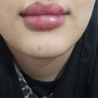 ژل وفیلر بوتاکس نورافیل ۱تومن فیلر بادی وباسن