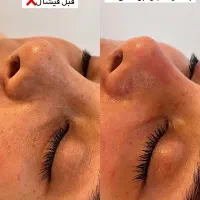 پاکسازی تخصصی پوست و لیفت ابرو روسی